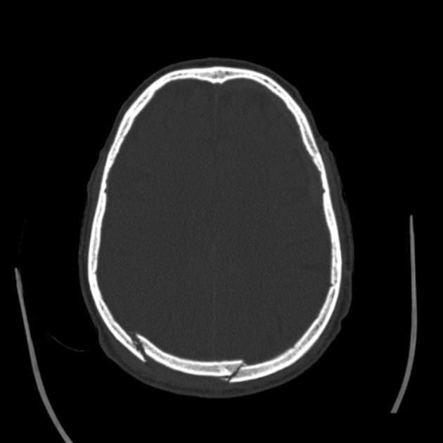 снимок перелом черепа на КТ